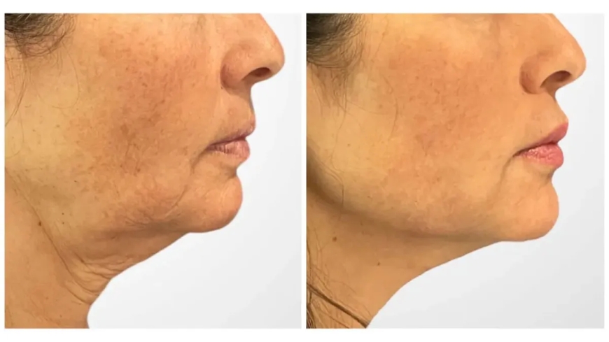 Can Thread Lift Treatment in Dubai Replace Botox and Fillers?