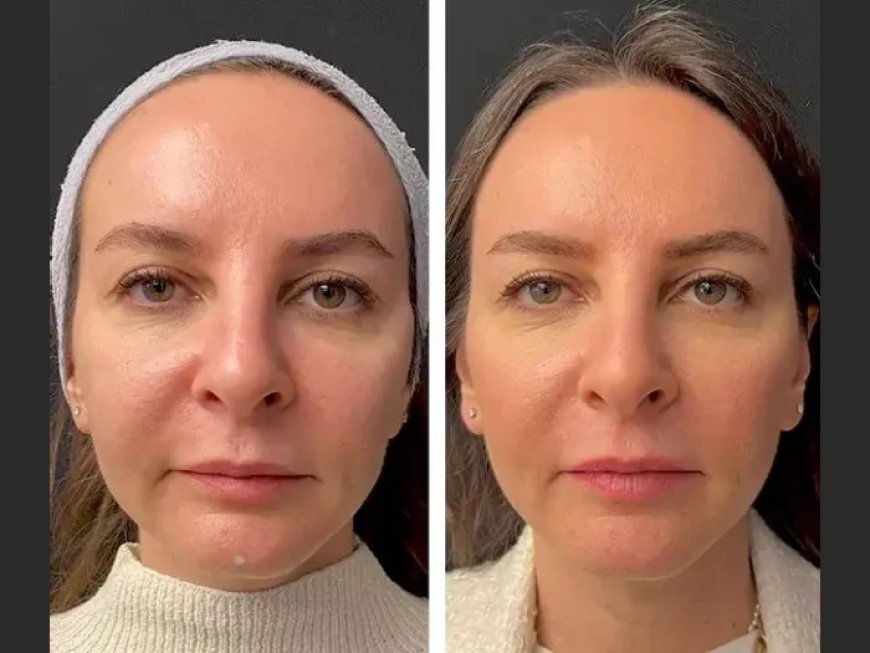 Mesotherapy vs. Fillers: Insights from the Best Doctors in Dubai
