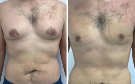 Best Gynecomastia Surgeon in Dubai: What You Need to Know About Post-Surgery Care