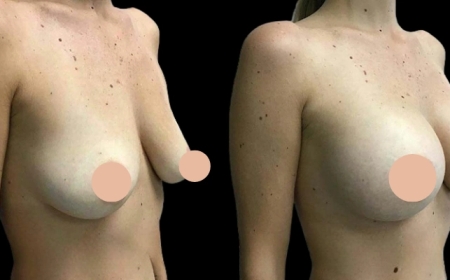 Redefining Confidence: Best Breast Augmentation Surgeons in Dubai