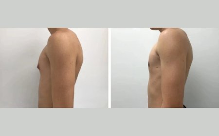 Best Gynecomastia Surgeon in Dubai: Understanding the Benefits of Liposuction vs. Excision