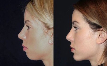 Best Plastic Surgeons in dubai for Chin Fillers: How It Works to Eliminate a Double Chin