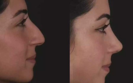 Septoplasty in Dubai: Functional Results That Last a Lifetime