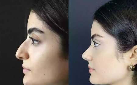 Revision Rhinoplasty in Dubai: Correcting Past Results