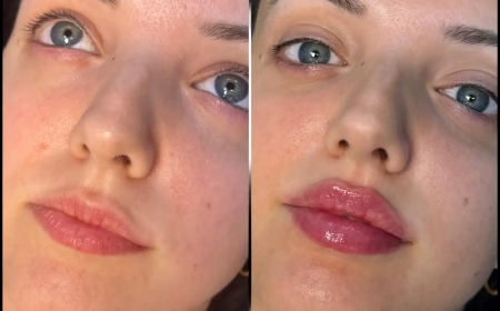 Experience the Best Results with the Best Doctors in Dubai for Fillers