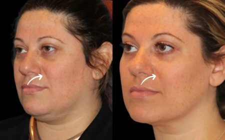 Regulatory Compliance: Sculptra Fillers Protocols at Dubai’s Best Aesthetic Clinic