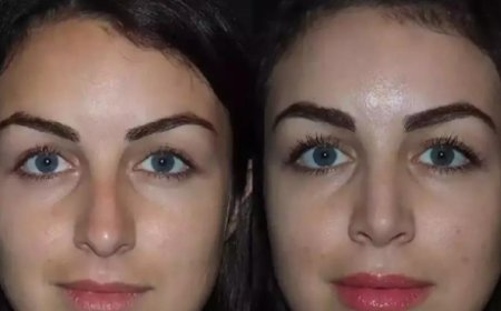 Affordable Excellence: Best Rhinoplasty Surgeon in Dubai