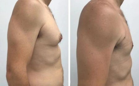 How the Best Doctors in Dubai Provide Results-Driven Gynecomastia Treatments