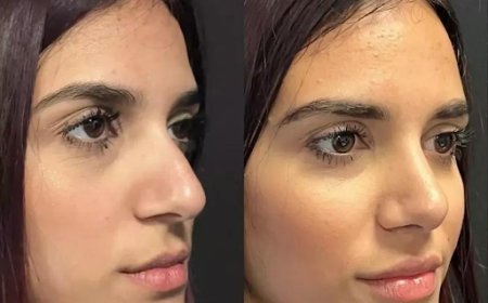 Before and After Rhinoplasty in Dubai: Real Patient Transformations