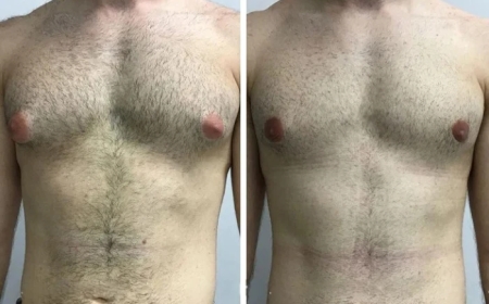 Gynecomastia in Dubai: What Age is Best for Treatment?