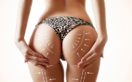 Why Butt Fat Transfer Surgery in Dubai is a Popular Alternative to Butt Implants