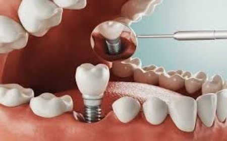 The Reasons Behind the High Demand for Full Mouth Dental Implants in Turkey