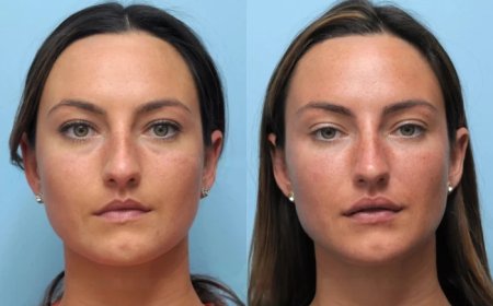 Your Guide to the Best Plastic Surgeon in Dubai for Thread Lift