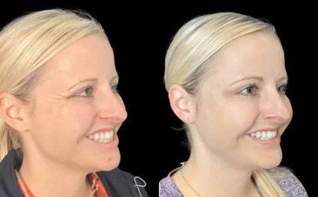Why Patients Choose the Best Plastic Surgeon in Dubai for Botox