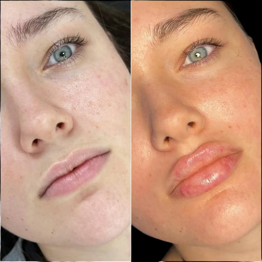 The Secret to Glowing Skin: Best Aesthetic Clinics in Dubai for Fillers