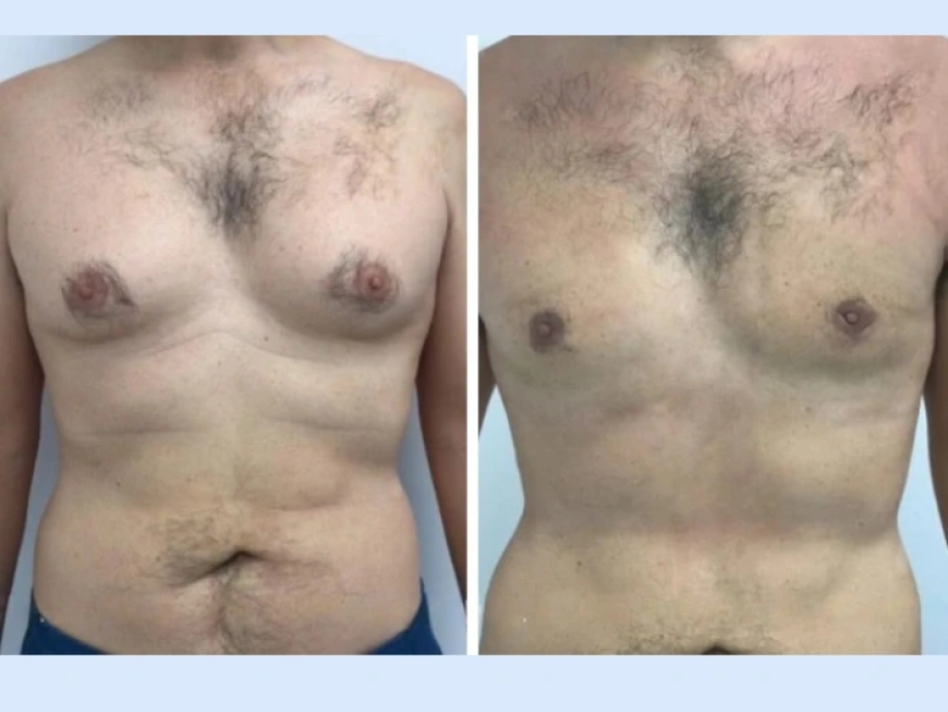 Best Gynecomastia Surgeon in Dubai: What You Need to Know About Post-Surgery Care