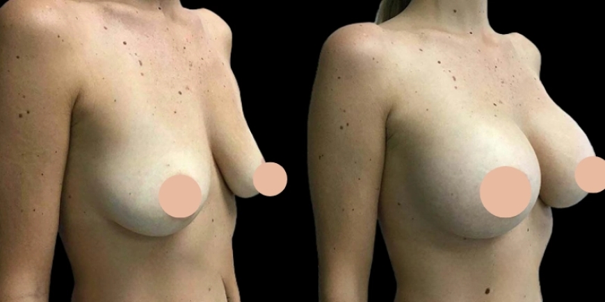 Redefining Confidence: Best Breast Augmentation Surgeons in Dubai