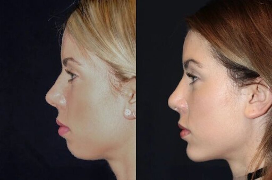 Best Plastic Surgeons in dubai for Chin Fillers: How It Works to Eliminate a Double Chin