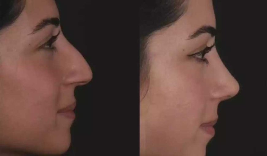 Septoplasty in Dubai: Functional Results That Last a Lifetime