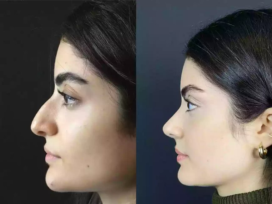 Revision Rhinoplasty in Dubai: Correcting Past Results