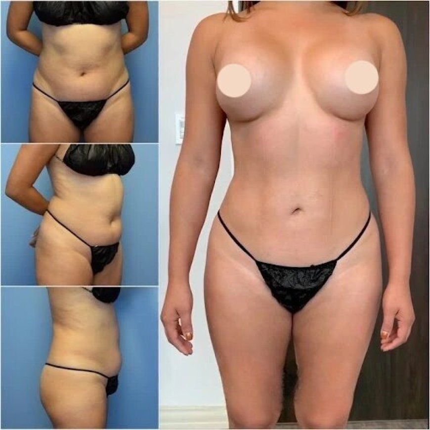 Best Body Contouring Surgeon in Dubai: Helping You Achieve a Toned Physique
