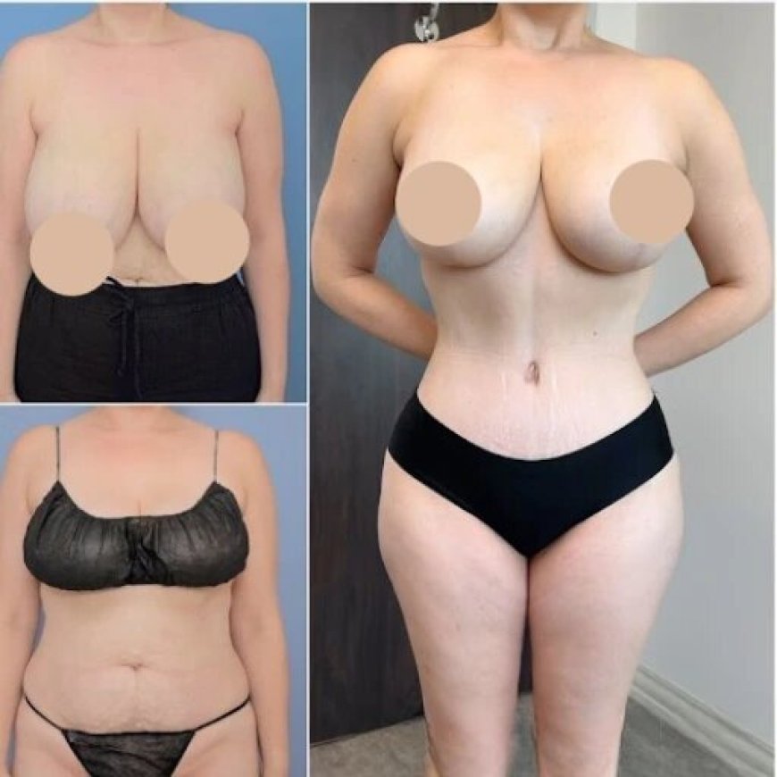 Choosing the Best Tummy Tuck Surgeon in Dubai for Safe and Effective Results