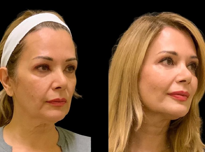 Cheek Fillers by the Best Doctors in Dubai: Perfectly Natural Results