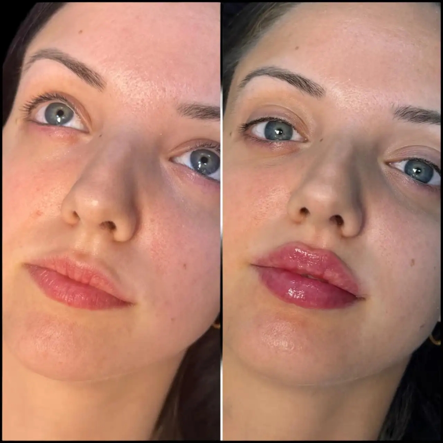 Experience the Best Results with the Best Doctors in Dubai for Fillers