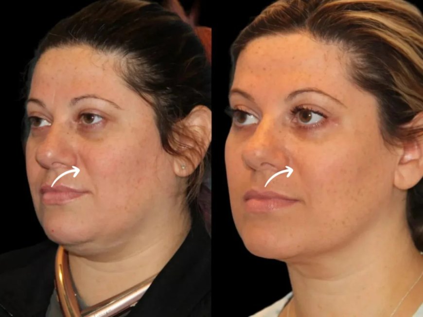 Regulatory Compliance: Sculptra Fillers Protocols at Dubai’s Best Aesthetic Clinic