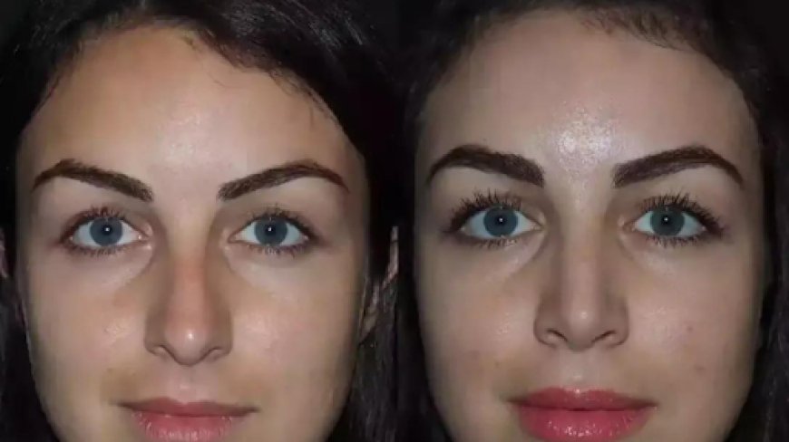 Best Doctors in Dubai for Functional and Cosmetic Rhinoplasty