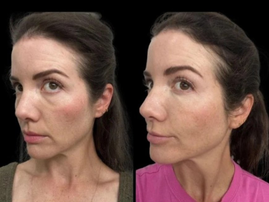Best Aesthetic Clinic in Dubai: What Makes Their Dark Circles Treatment So Popular
