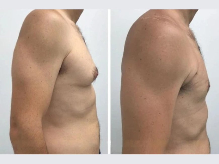 How the Best Doctors in Dubai Provide Results-Driven Gynecomastia Treatments