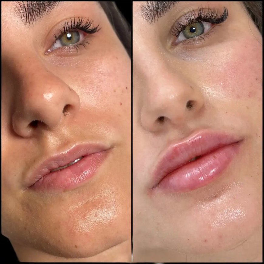 Best Aesthetic Clinics in Dubai for Dermal Fillers: Top Treatments for Wrinkles
