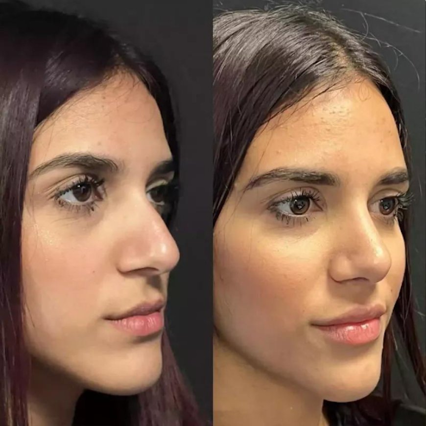 Before and After Rhinoplasty in Dubai: Real Patient Transformations