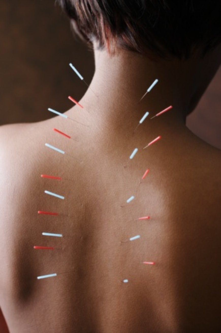 Acupuncture for Menopause Relief: Natural Support for Every Stage