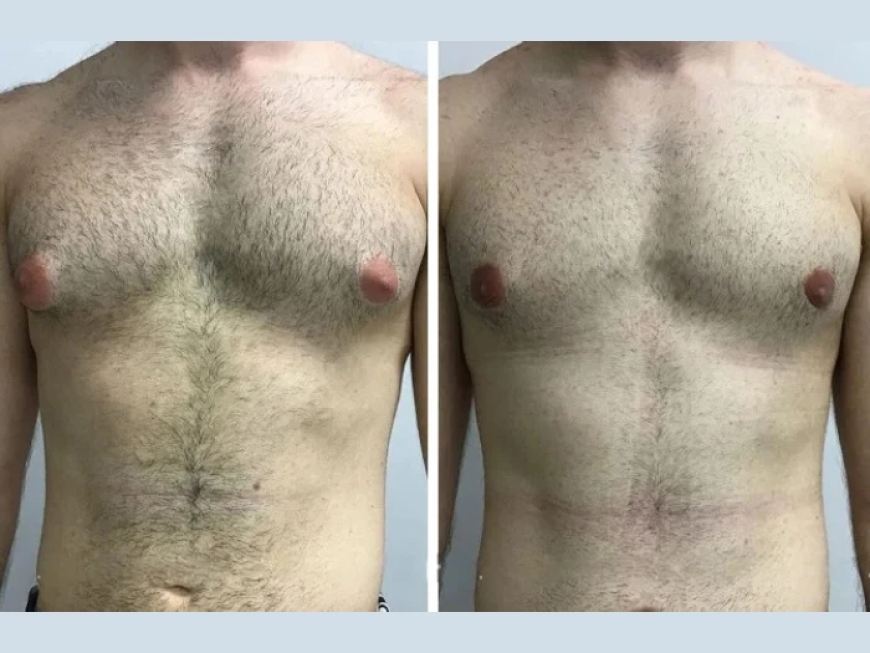 Gynecomastia in Dubai: What Age is Best for Treatment?