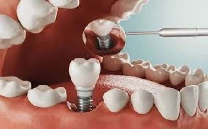 The Reasons Behind the High Demand for Full Mouth Dental Implants in Turkey
