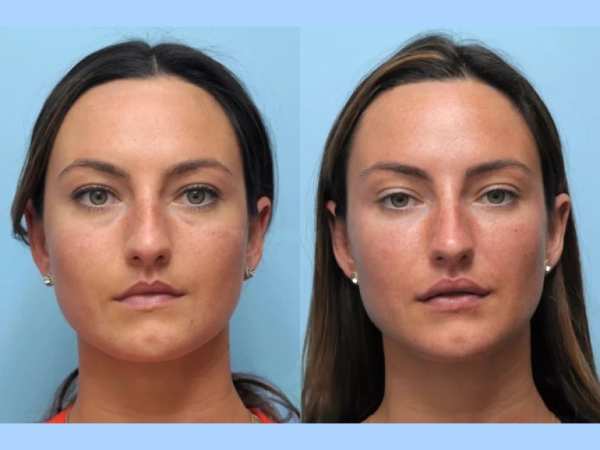 Your Guide to the Best Plastic Surgeon in Dubai for Thread Lift