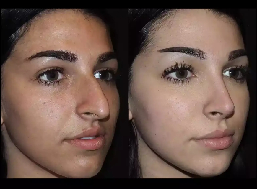 How the Best Septoplasty Surgeon in Dubai Improves Breathing