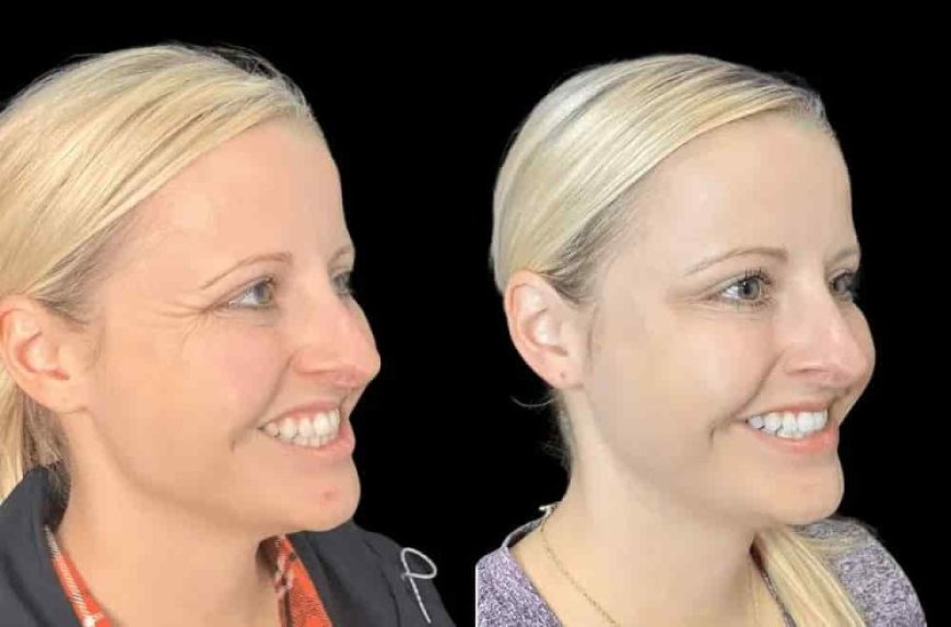 Why Patients Choose the Best Plastic Surgeon in Dubai for Botox